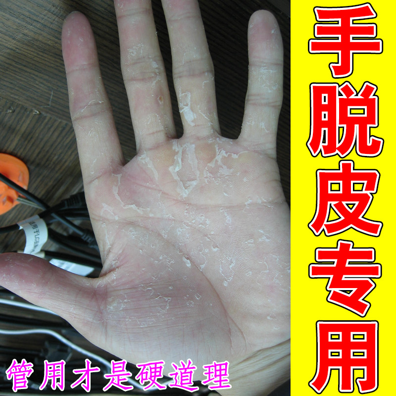 手脱皮专用儿童季节性过敏蜕皮角质化增厚型感染起皮掉屑手指头痒