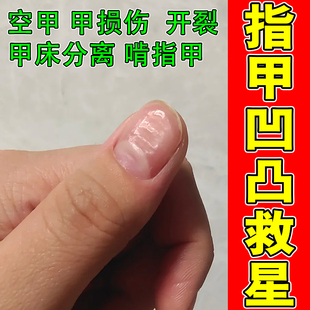 指甲凹凸不平修复液甲床分离甲面竖纹指甲受损再生精华液