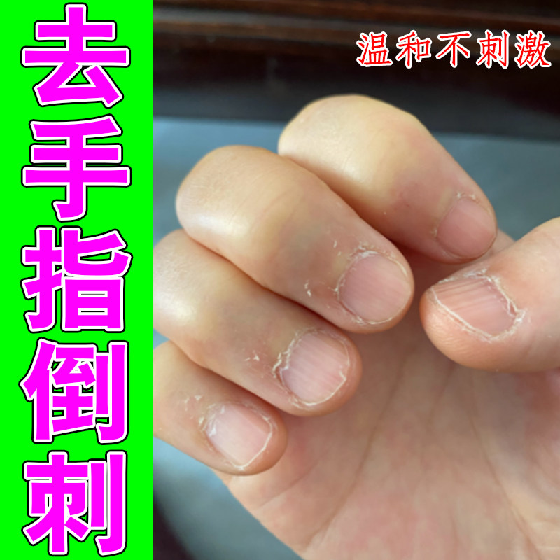去手指倒刺肉刺消手部皮肤干燥起皮蜕皮干痒起硬皮边缘撕裂修护霜