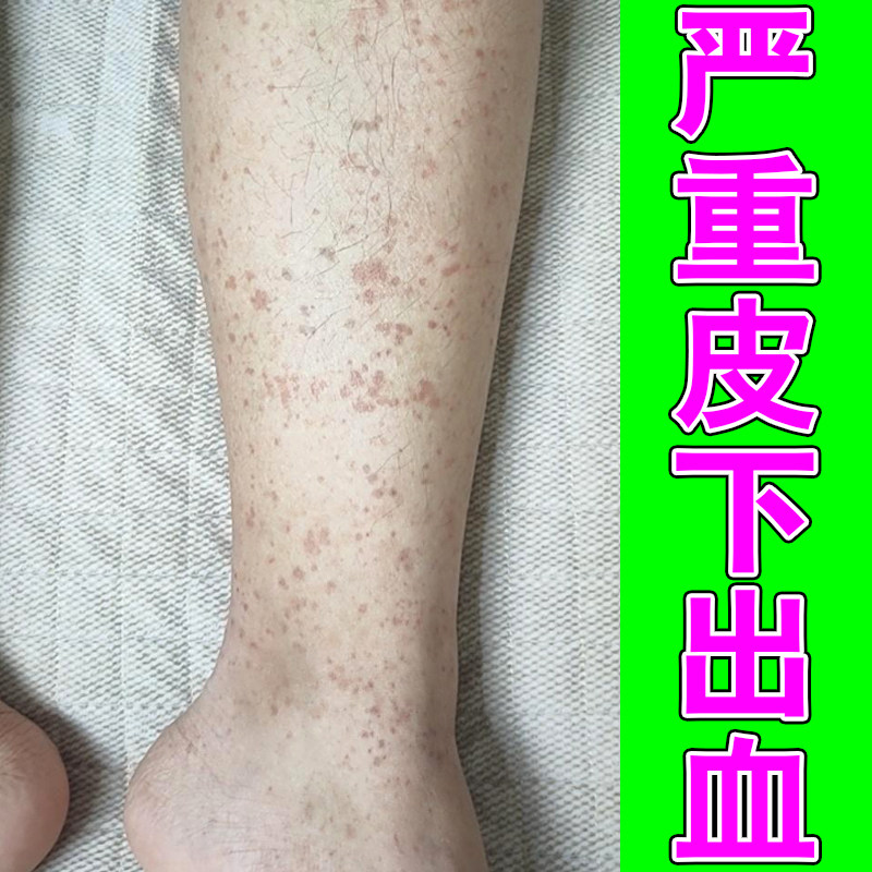 下肢紫红色斑点皮下瘀斑莫名红点肌肤成片紫点小腿斑驳红印皮肤痒