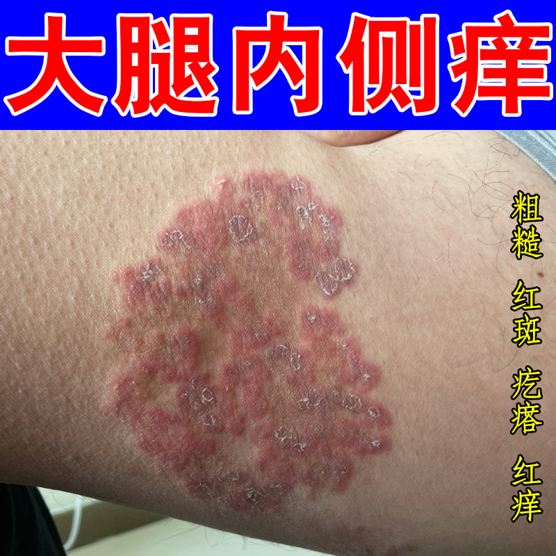 大腿内侧痒粗糙红肿掉屑脱皮股痒疙瘩感染去两侧根部长红斑草本膏