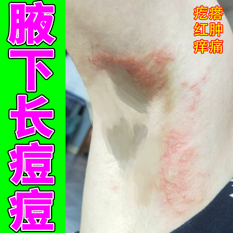 腋下长痘痘疙瘩皮肤干燥痒腋下出汗多痒红肿裂口红斑有异味痒痛