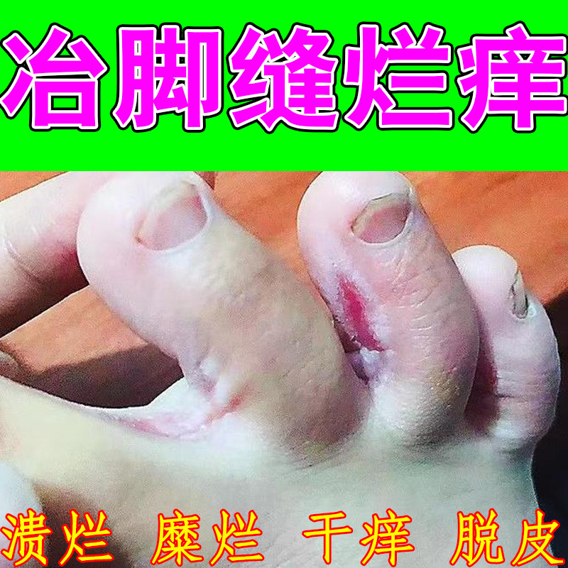 脚趾缝干燥脱皮脚冶脚指缝裂口蜕皮糜干脚底裂脚后跟粗糙药乳