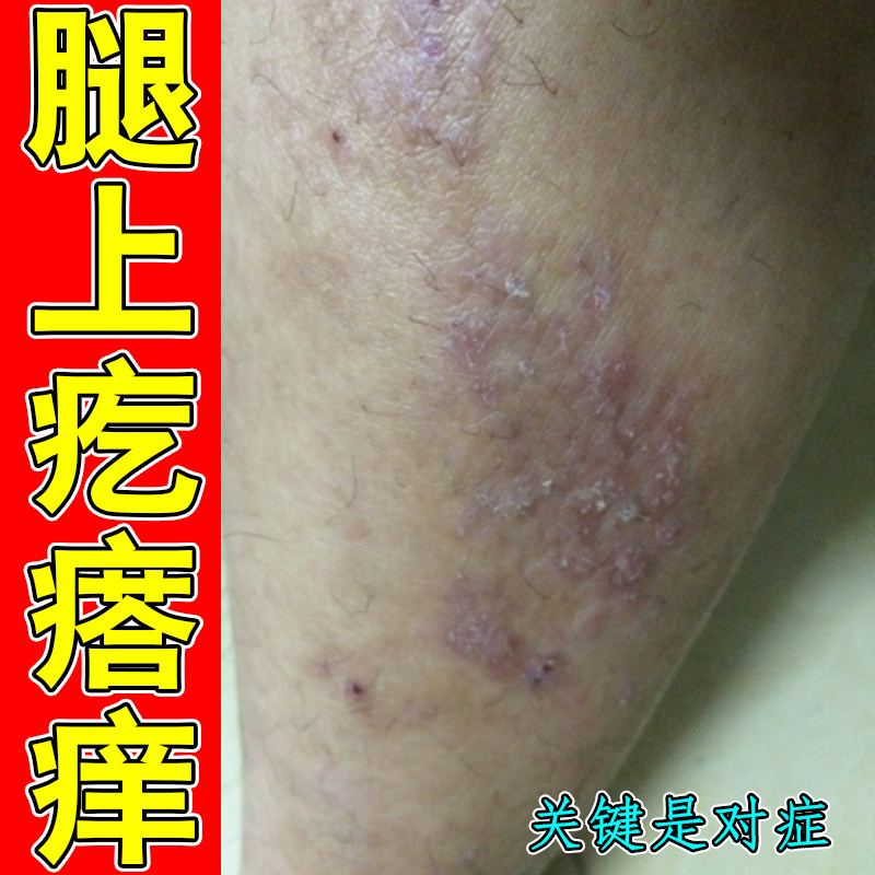 腿上疙瘩痒掉屑脱皮干燥粗糙痒神经性皮肤过敏痒长痘刺挠一挠就红