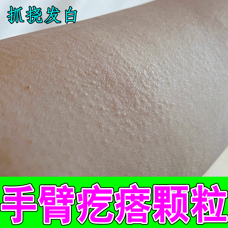 手臂疙瘩颗粒皮肤干燥痒粗糙鸡皮疙瘩毛周角化症抓挠起皮掉屑专用