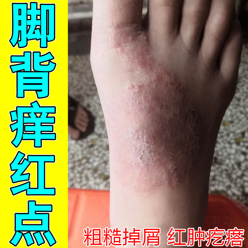 脚背痒红点脚趾间起水泡疙瘩红肿过敏感染粗糙掉屑刺挠干燥长红斑