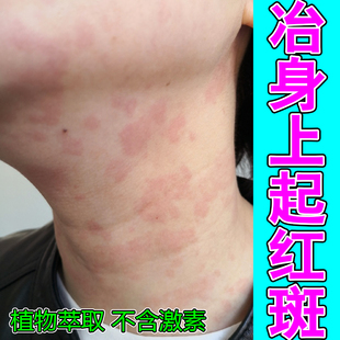 冶身上起红疙瘩皮肤干痒长红斑脖子红痒红点颈部出汗刺挠痒外用膏
