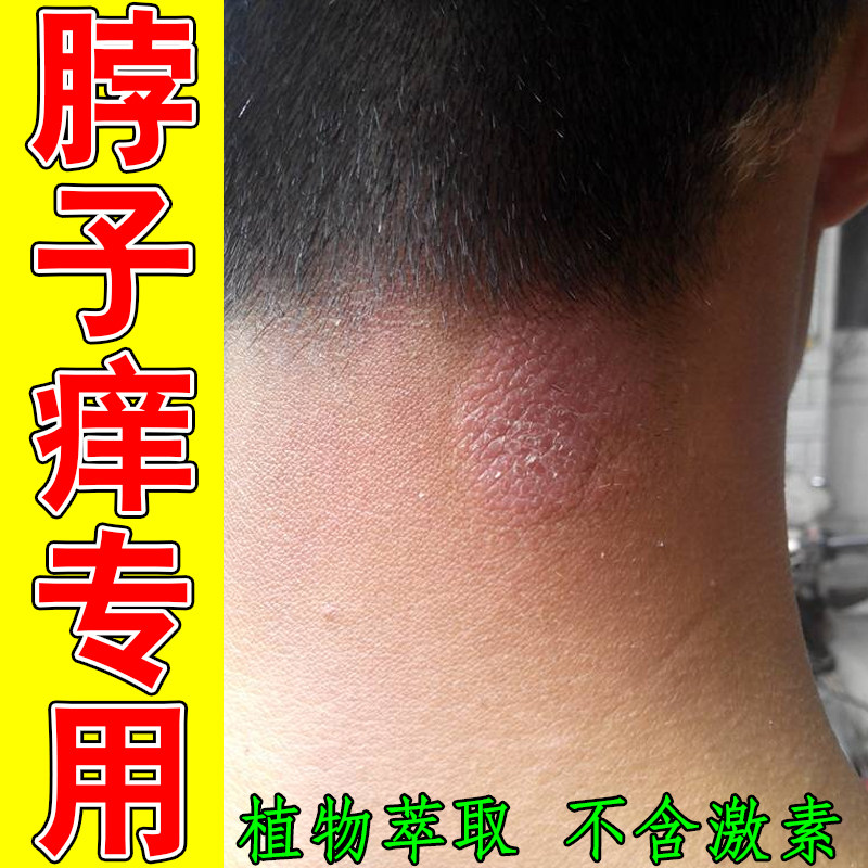 脖子痒专用神经性皮肤过敏干燥粗糙掉屑长红疙瘩痘起红斑出汗红痒