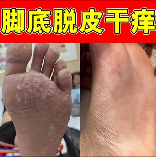 脚臭脚干脚脱皮起泡水泡汗脚丫蜕皮脚心出汗湿红脚药乳膏