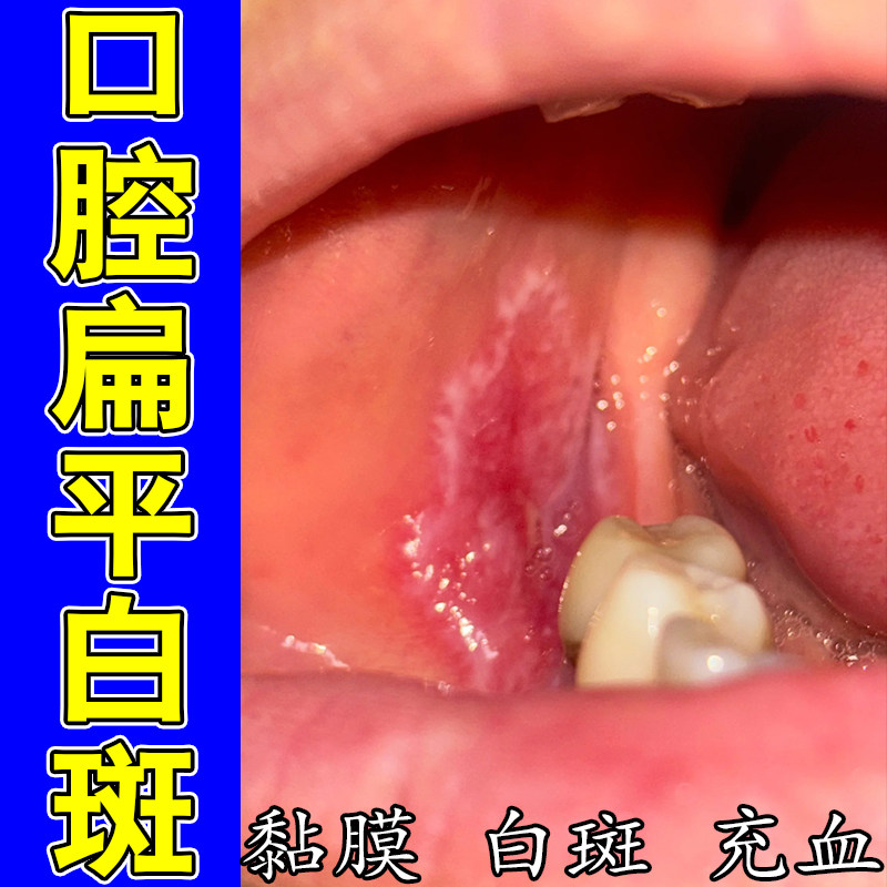 嘴巴内侧内壁黏膜纤维化白斑修护口腔黏膜顽固草本修护喷剂