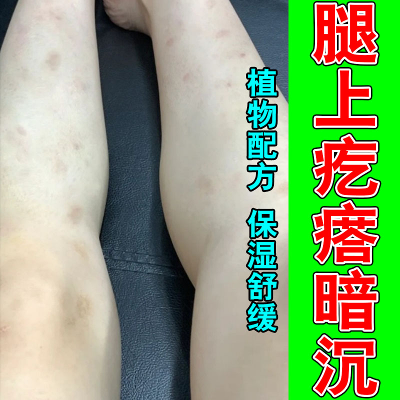 冶蚊虫叮咬黑色素沉淀黑印淡化抓挠深色舒缓印按摩乳膏