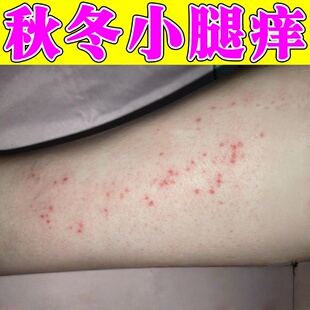 秋冬天小腿皮肤痒干燥治腿痒起小红点红疙瘩疹子掉皮屑的膏