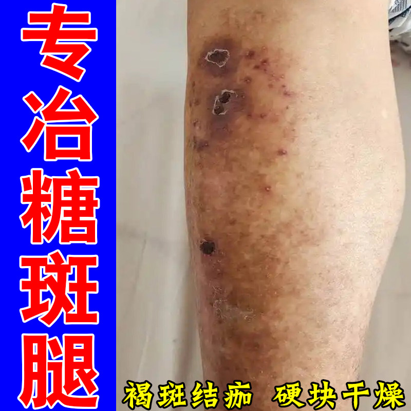 糖斑腿老年人全身干燥腿痒老人身上皮肤痒糖斑褐色干燥疙瘩痒膏