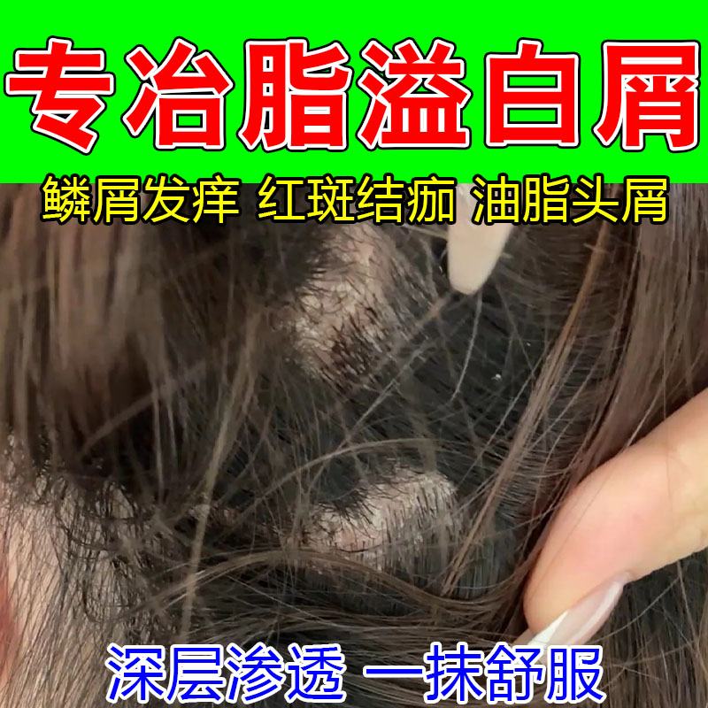 冶头皮斑块头痒疼红肿结痂头部发痒红斑屑周大片白色鳞屑草本乳膏