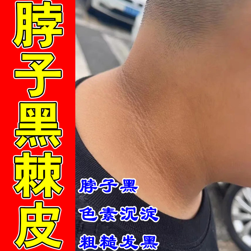 去脖子黑棘皮颈部黑色素沉淀胳膊黑腋下黑全身通用淡化暗沉专用膏