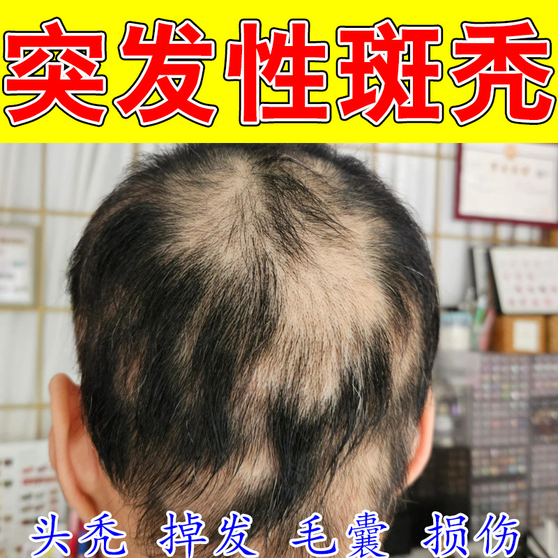 头顶大面积脱发秃顶修护激活毛囊何首乌侧柏草本养发增发生发喷剂