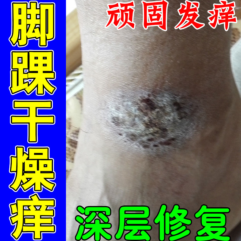 脚踝长疙瘩痒脚脖子皮肤干燥起皮屑痒刺挠角化型足疙瘩越抓越痒