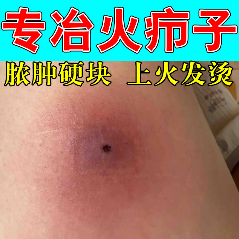 腿上长火疖子上火硬块红疙瘩红肿腿上火疖子专用草本保湿软膏