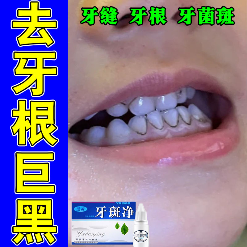 牙根发黑去牙垢牙菌斑牙烟渍牙斑净去牙缝发黑清理斑牙净牙液