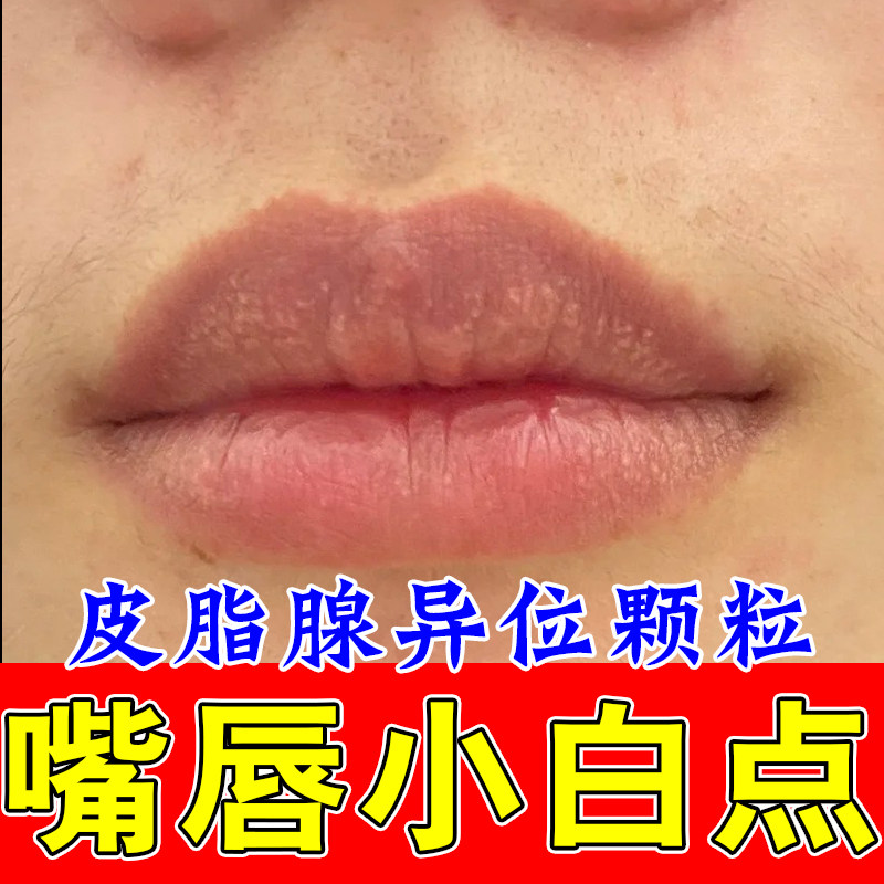 嘴唇长小白点小颗粒皮脂腺异位颗粒唇部干燥开裂起干皮粗糙修复膏