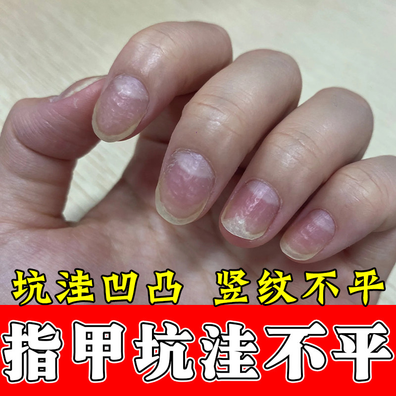 专冶指甲凹凸不平开裂空甲指甲受损甲床分离甲面竖纹分层修复甲液