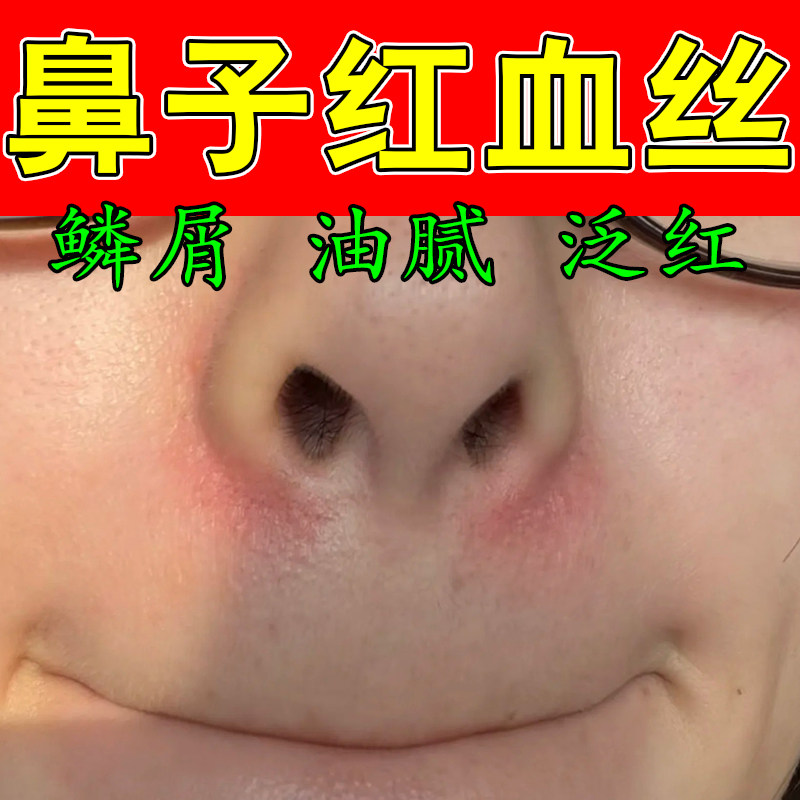 冶脂溢性鼻子红面部鼻子两侧马拉色菌干燥粗糙泛红鼻子干燥起皮膏