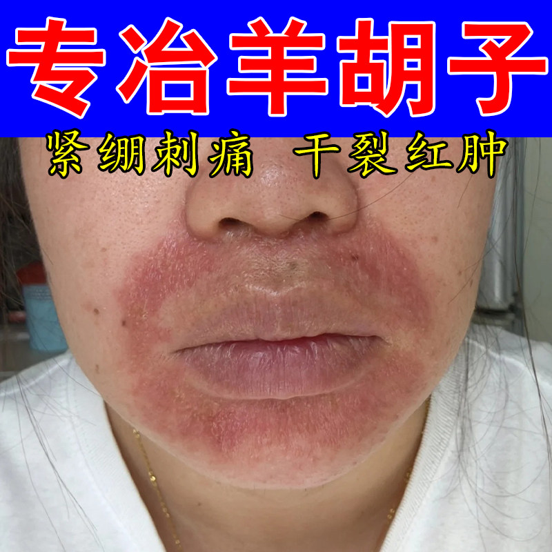 小孩舔嘴唇羊胡子发红儿童嘴巴周红干燥起干皮裂结痂红肿疼修复膏