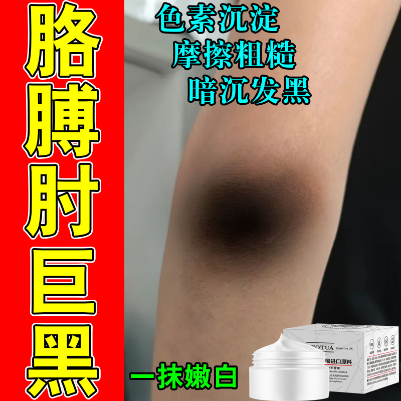 去胳膊肘黑皮肤脖子黑色素沉淀手肘关节黑棘皮黑皮角质按摩膏