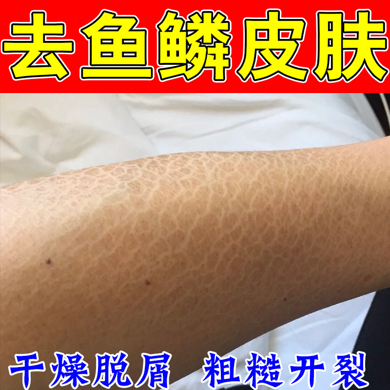去鱼鳞皮肤疙瘩毛囊角化专用膏白纹起屑干燥皮肤干燥毛周鱼鳞甘油