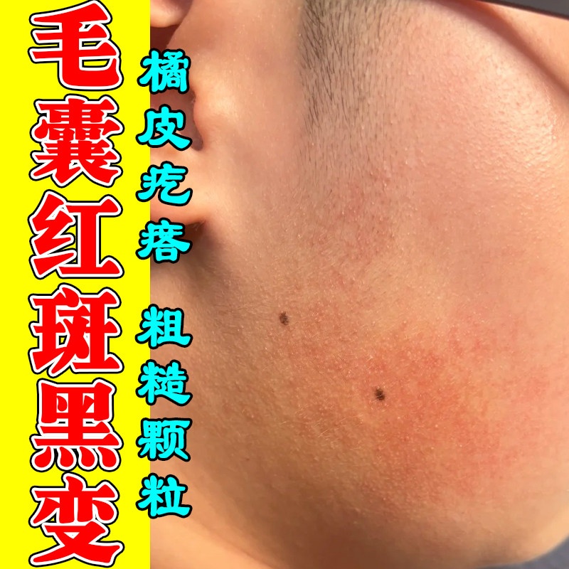 面部毛囊红斑黑变疙瘩脸颊两边小疙瘩红点皮肤毛囊毛周角化修护膏