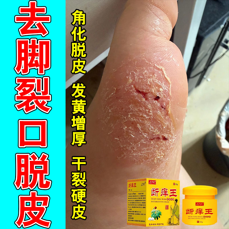 掌跖手足手脚干燥粗糙起皮干裂脱皮泛红角质增厚外用呵护软膏