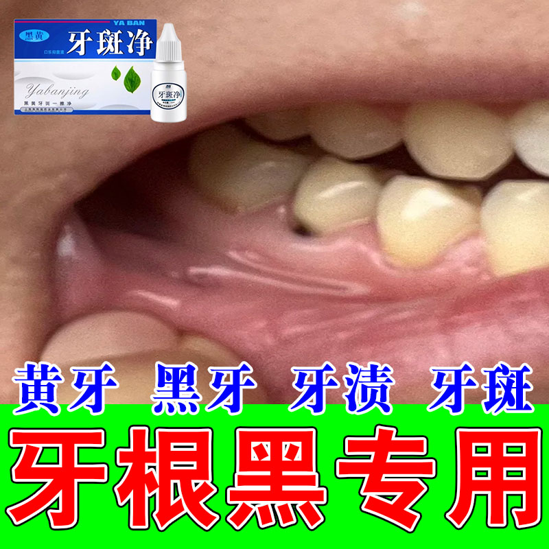 牙菌斑牙根发黑牙垢牙黑清洁牙黑斑黑渍污垢黄牙牙齿净牙液