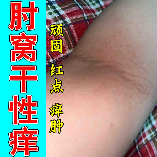 皮肤干燥起疙瘩红点粗糙红肿红疙瘩痒掉屑换季体表修护软膏