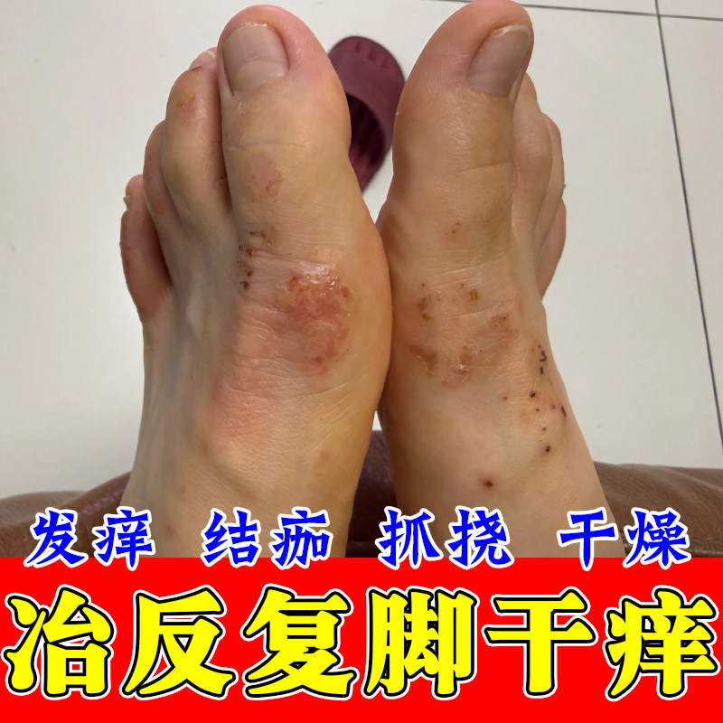 脚侧起屑角质粗糙痒脚侧面红点粗糙红疙瘩脚干燥脱屑植物萃取膏