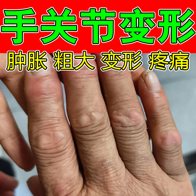 手指关节僵硬肿痛草本膏老人手指粗大弯曲费劲僵硬关节草本软膏