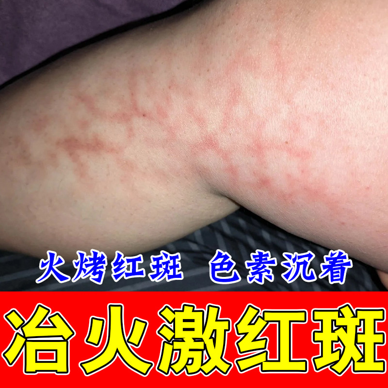 火激红斑修复烤火高低温烫伤腿部起水泡网状斑毛细血管扩张专用膏