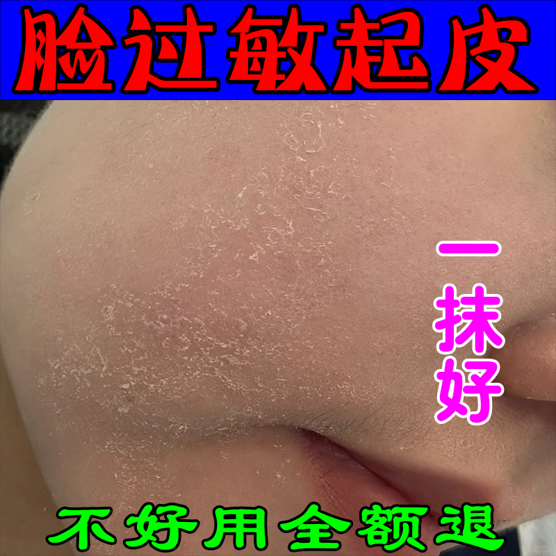 脸上秋冬过敏干燥起皮鼻子红起皮脸干掉皮脸过敏皮肤干燥脱皮甘油
