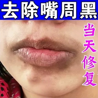嘴角黑色素沉淀去除嘴角两边发黑改善唇周黑嘴巴周边黑暗沉专用膏