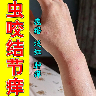 冶虫螨侵扰身上红疙瘩小包发痒难耐抓挠破皮刺痛草本温和乳膏