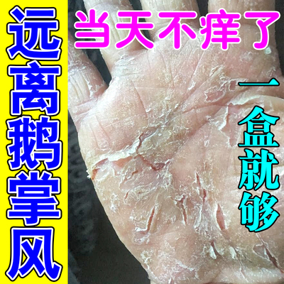 鹅掌风专用手癣膏药手上干裂脱皮粗糙真菌感染起水泡痒掉皮