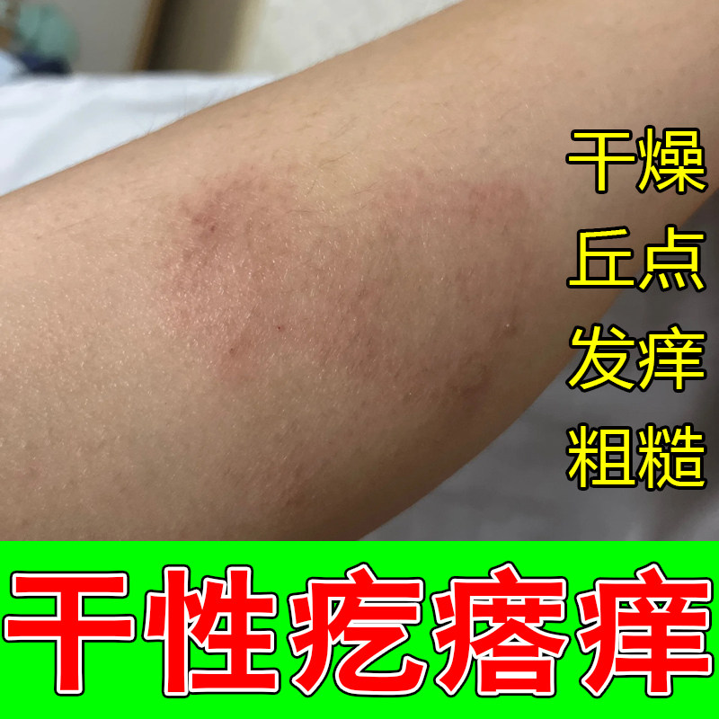 冶干燥性痒疙瘩发痒掉屑粗糙红肿起红疙瘩红点换季过敏外用修护膏