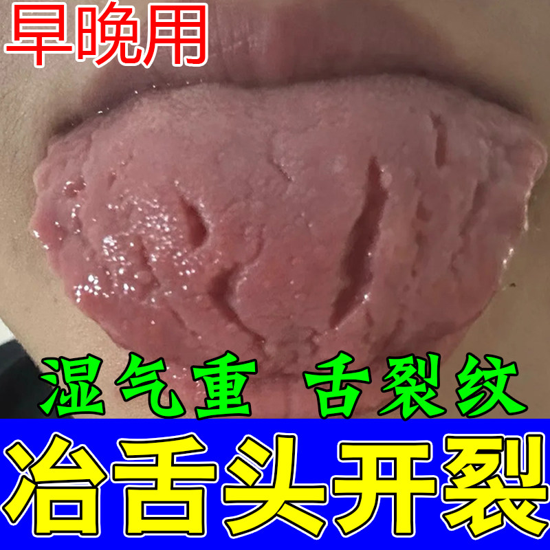 舌头裂纹有齿痕舌苔白厚舌齿痕舌调理灼口修护草本舒缓喷剂