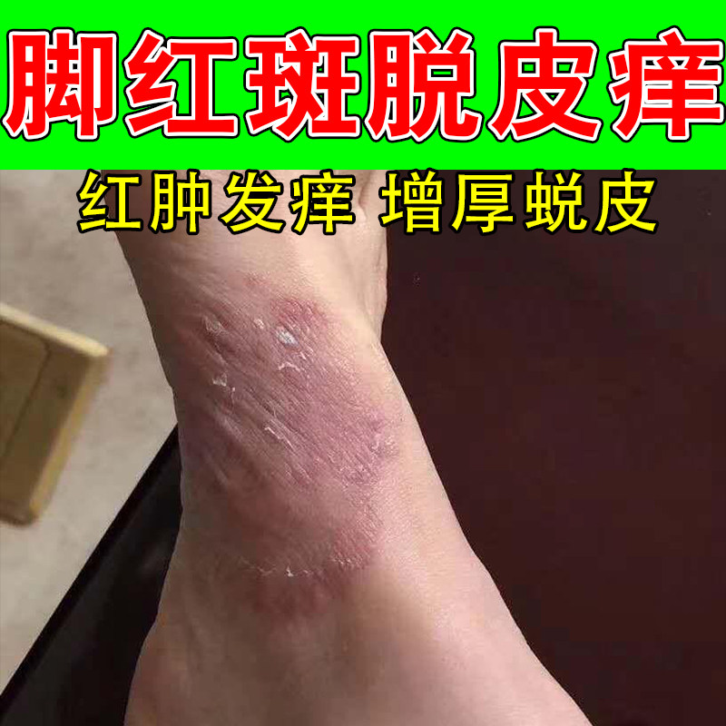 冶脚上脱皮起屑痒脚侧脱屑角化疙瘩起红点干燥粗糙痒修护软膏