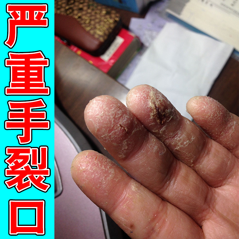 手裂口干裂修复霜秋冬指甲缝干裂防手指裂口开裂脱皮痒真菌