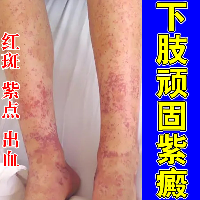 冶紫癜色素过敏性癜四肢皮下出血红点瘀斑血管草本舒缓膏