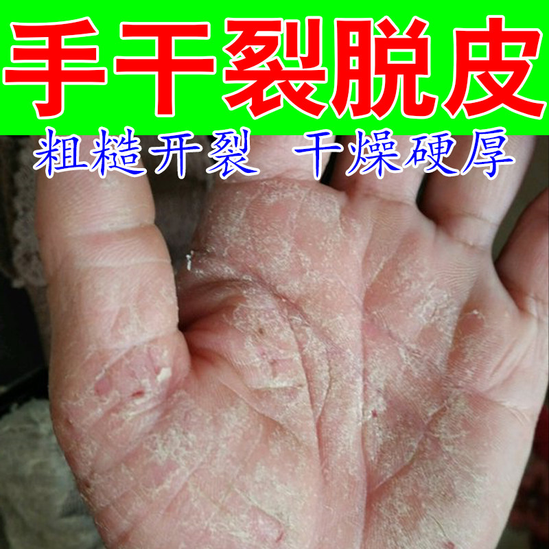 干燥粗糙手起皮严重干裂真菌手脚起干燥皮粗糙皮起屑保湿修护膏