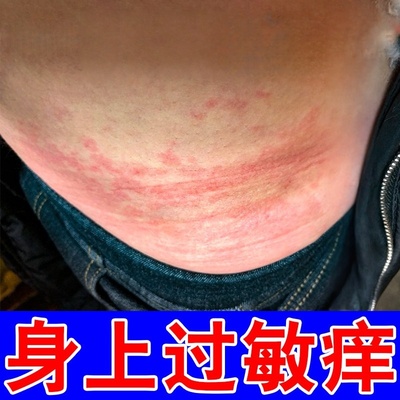 身上起红疙瘩痒膏治皮肤痒的春天过敏长红点痒干燥