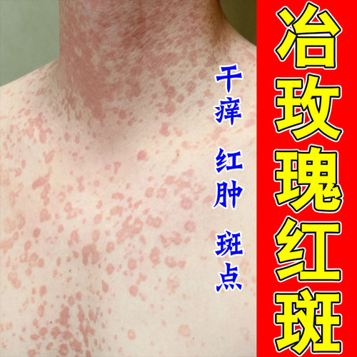 玫瑰泛红斑点身上腿上大面积爆发红斑痒肿保湿起红点修护膏