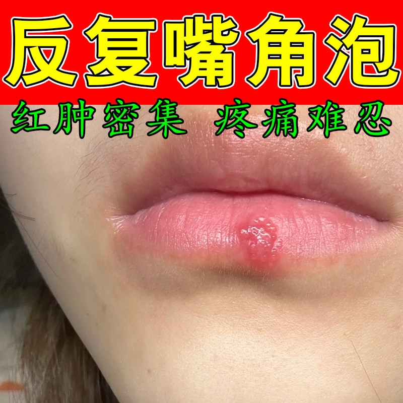 嘴唇泡嘴角上火起泡红肿痒嘴巴周上火干裂干燥脱皮小水泡疼专用膏
