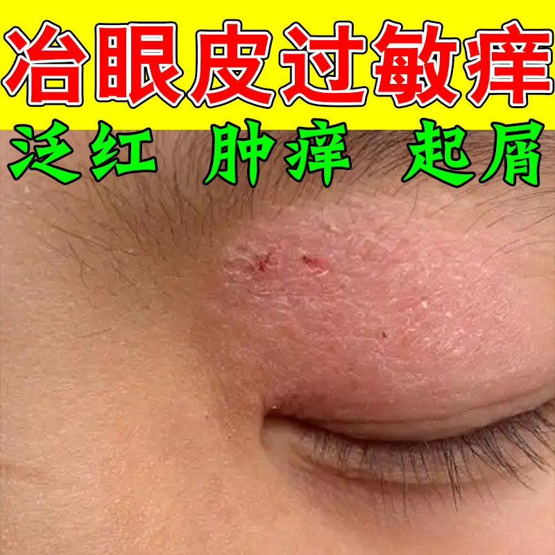 眼皮起屑眼睛周围眼角痒干燥起皮脱掉屑红肿过敏发痒神经性皮屑膏